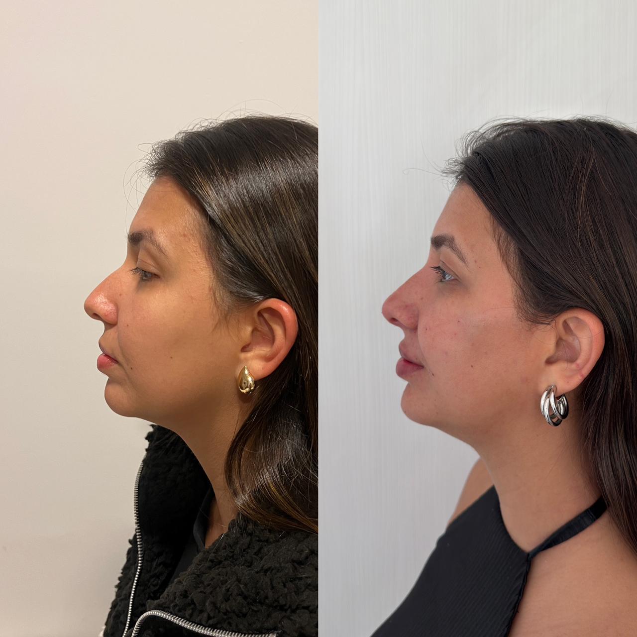 Antes e depois — Rinomodelação