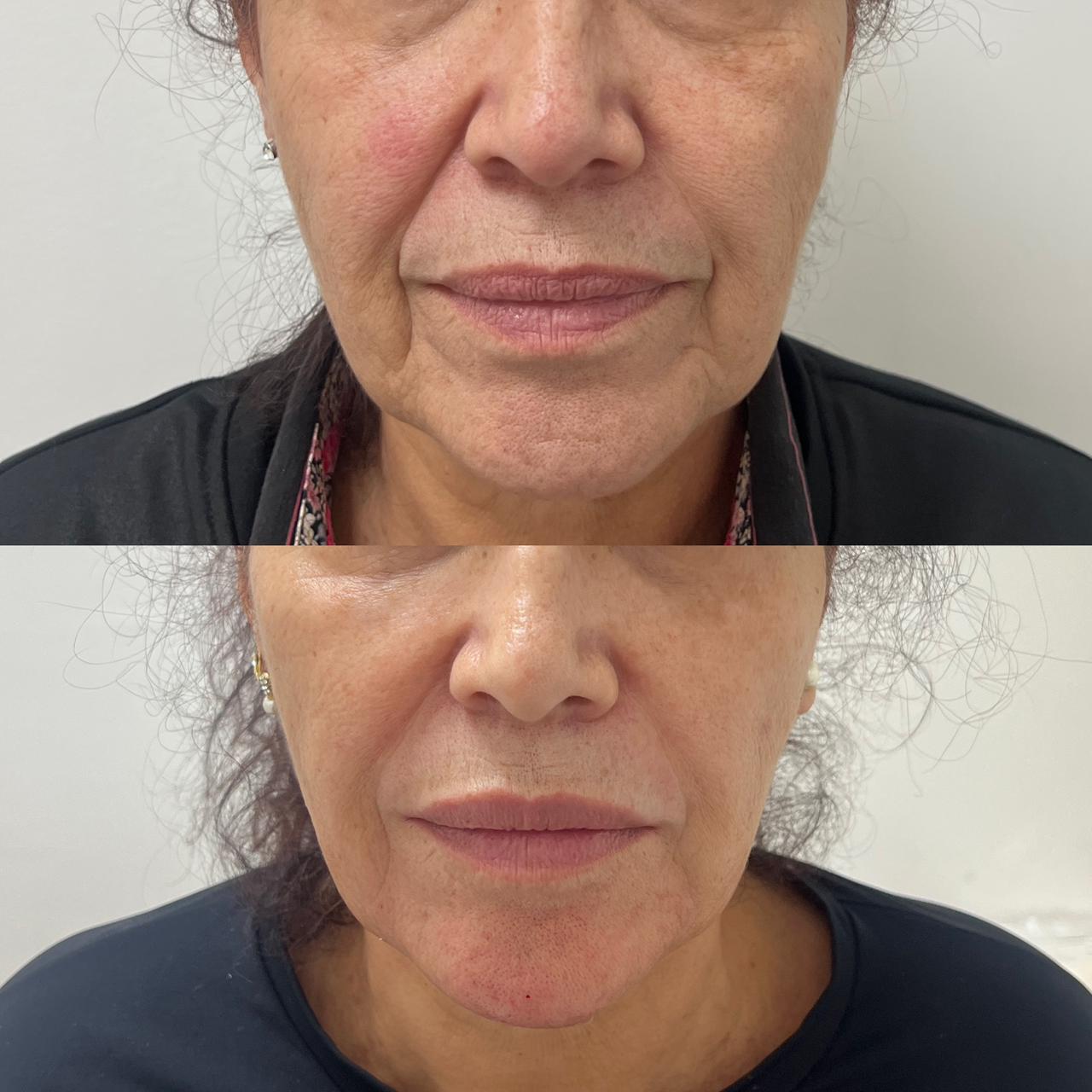 Antes e depois — Rejuvenescimento Facial