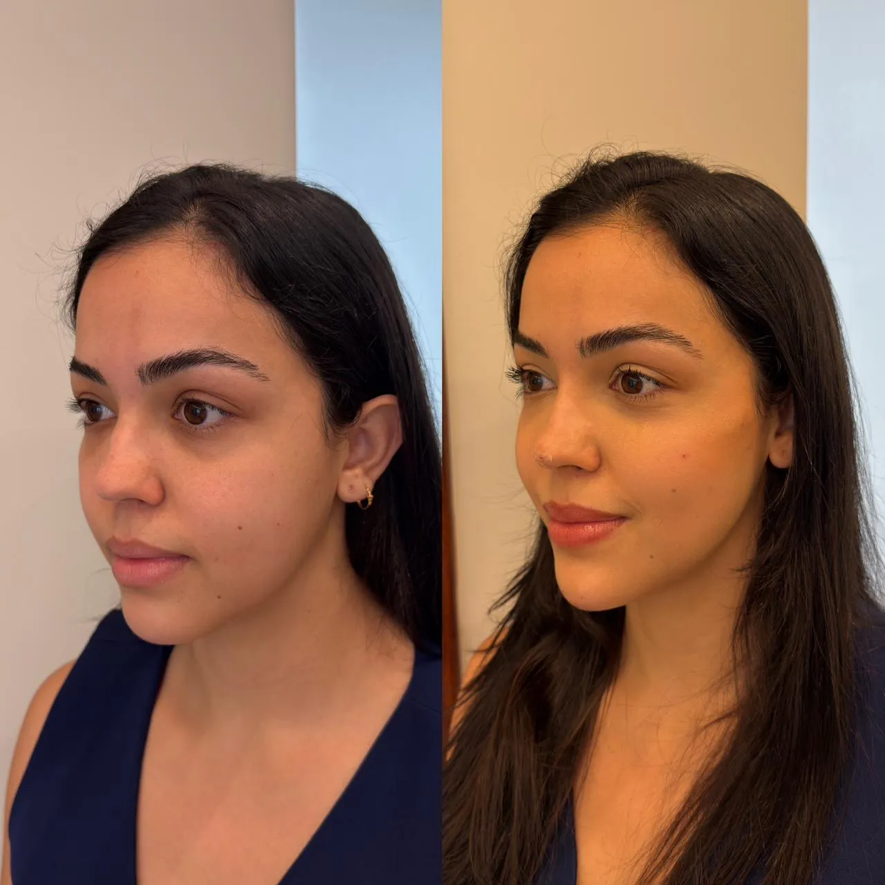 Antes e depois — Rinomodelação