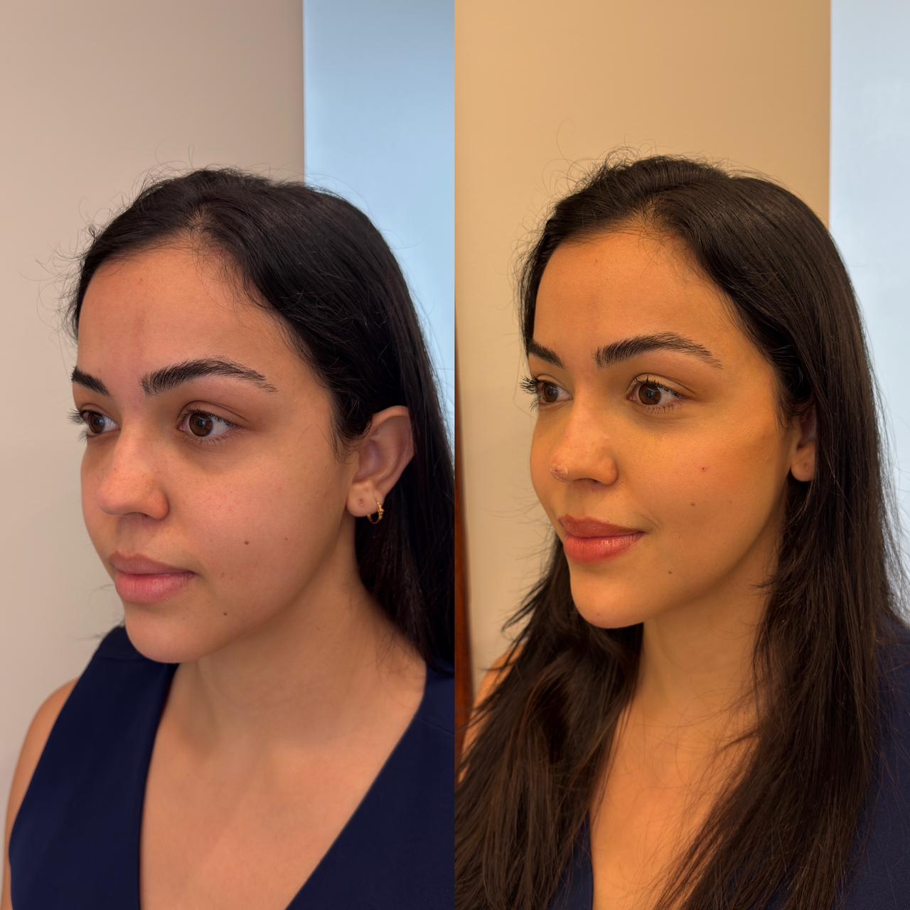 Antes e depois — Rinomodelação