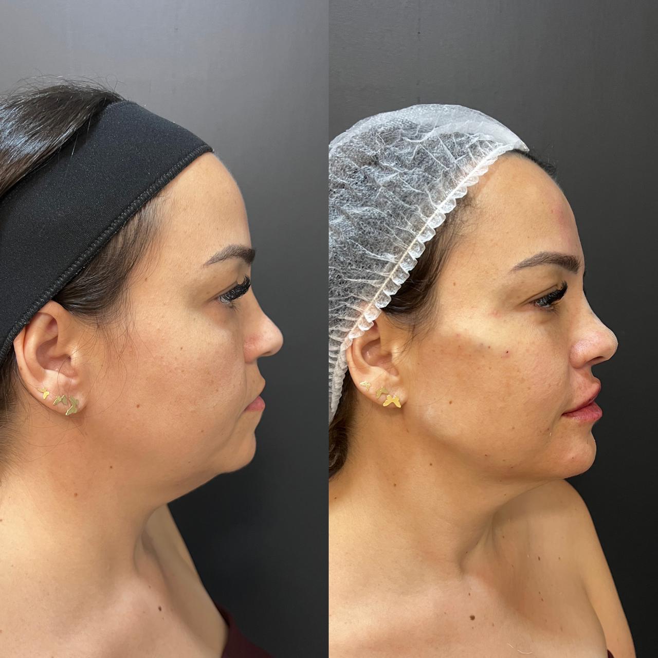 Antes e depois — Preenchimento Labial