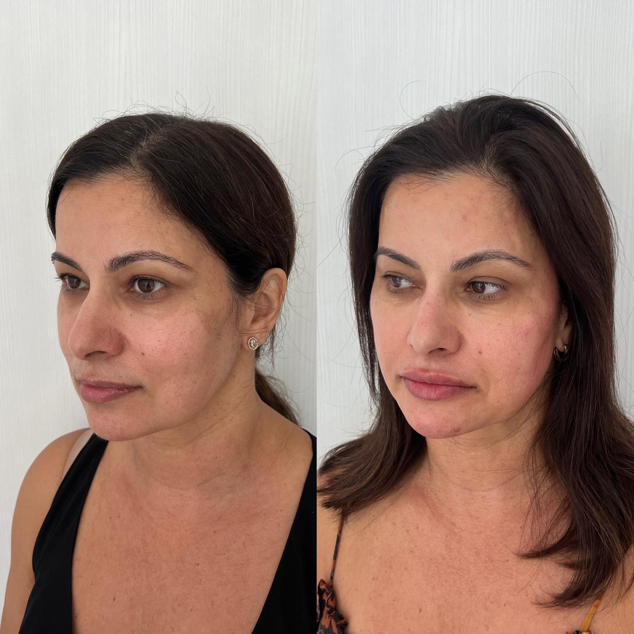 Antes e depois — Harmonização Facial